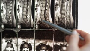 spinal stenosis