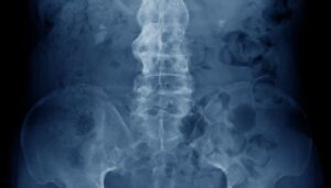 spondylarthrite et chiropratique