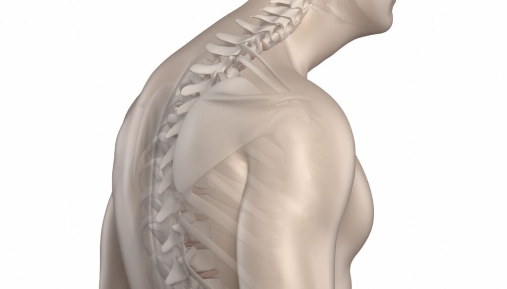 hyperkyphosis and chiropractic