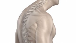 hyperkyphosis and chiropractic