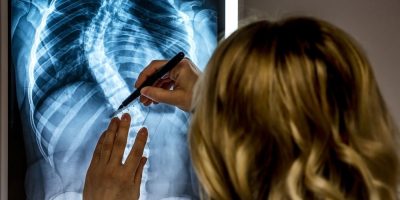 Scoliosis and chiropractic