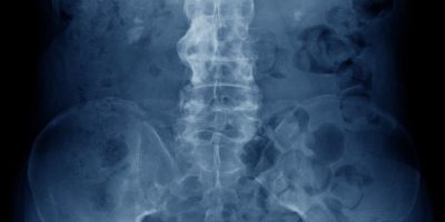 espondilitis y quiropráctica